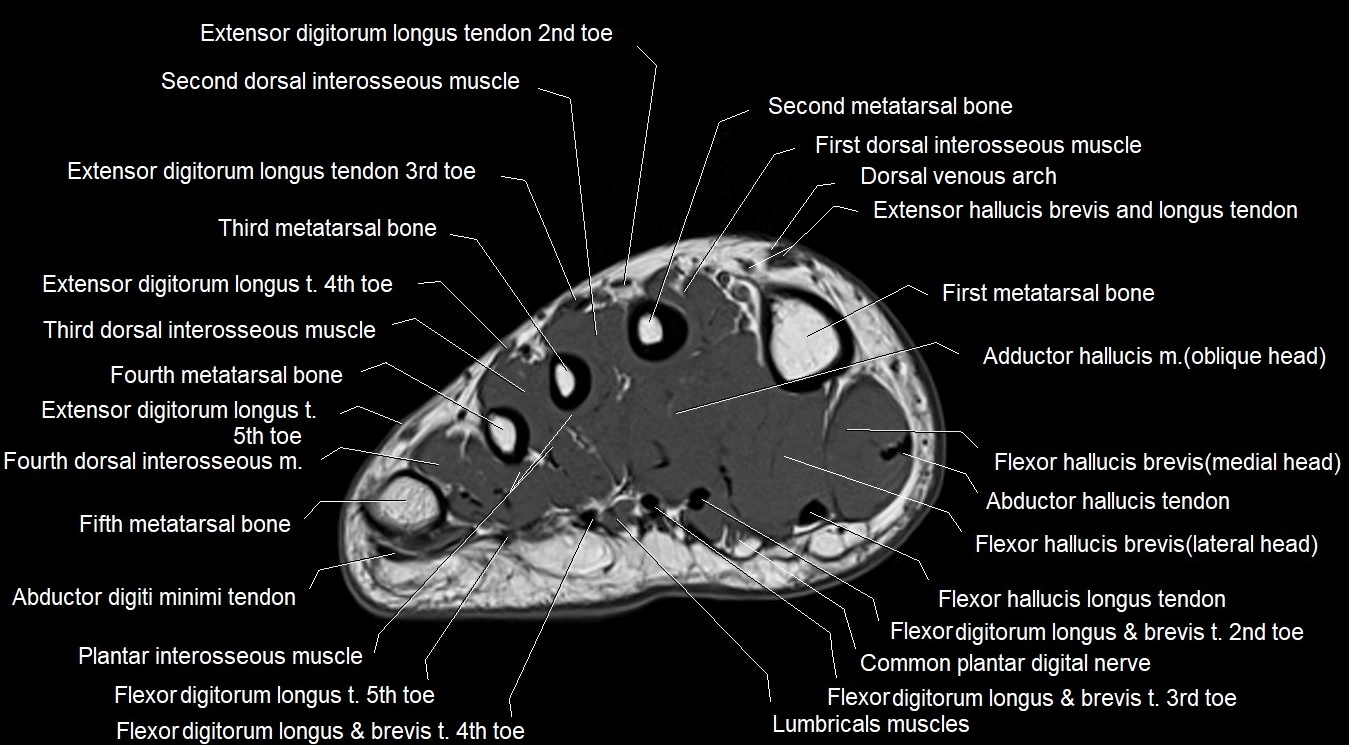 MRI 3T foot axial cross sectional anatomy image 20.webp